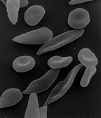 Misshapen red blood cells characteristic of sickle cell anemia