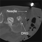 x-ray image of needle being placed into the sensory ganglion