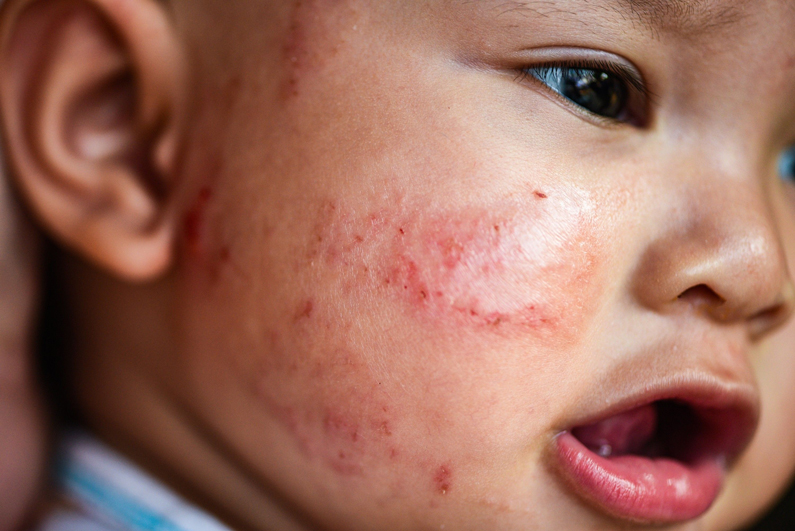close-up of eczema on a baby's face