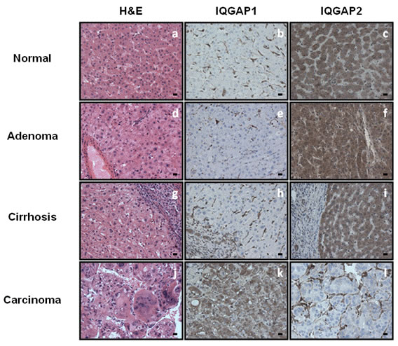 IQGAP1 and IQGAP2 protein expression is altered in hepatocellular carcinoma