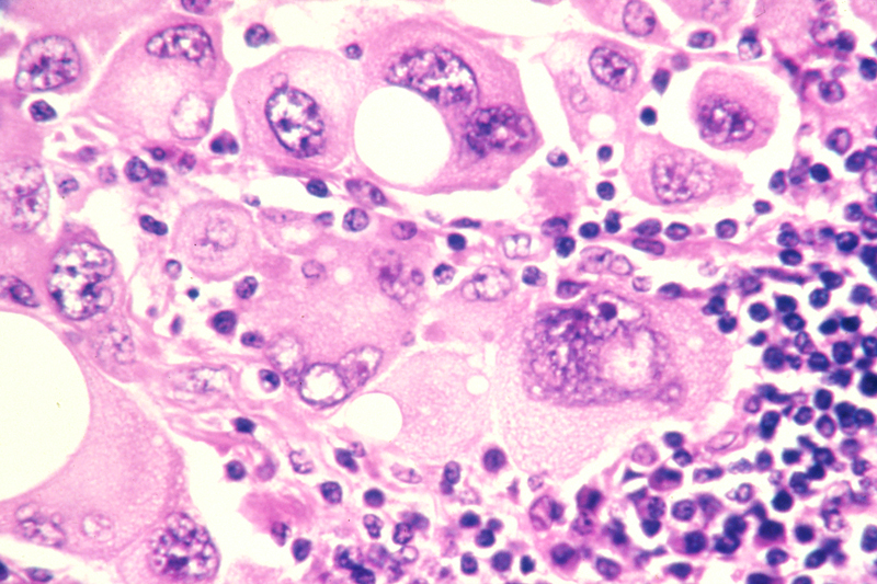 melanoma cells