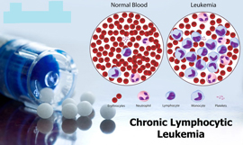 Chronic lymphocytic leukemia and normal blood cells comparison
