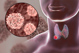medical illustration of a human throat highlighting thyroid cancer cells