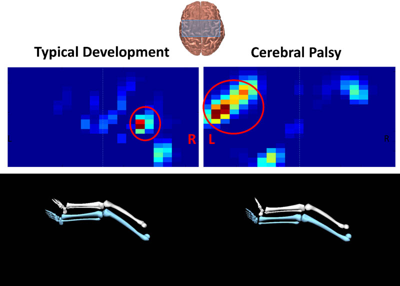 Typical Development and Cerebral Palsy